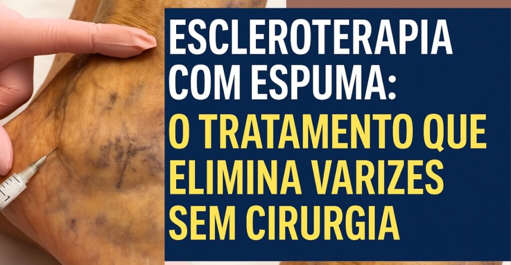 escleroterapia com espuma