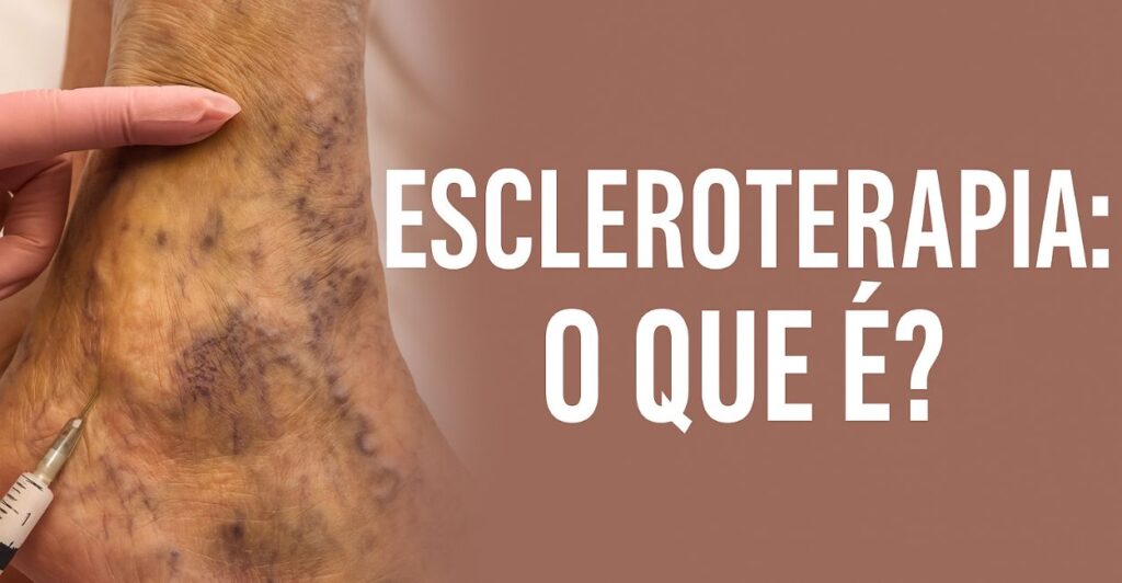 escleroterapia o que é